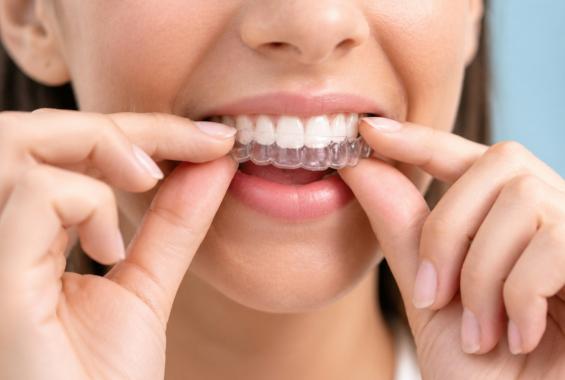 Teeth Whitening